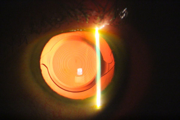 Laser Cataract Surgery by Synergy Eye Care