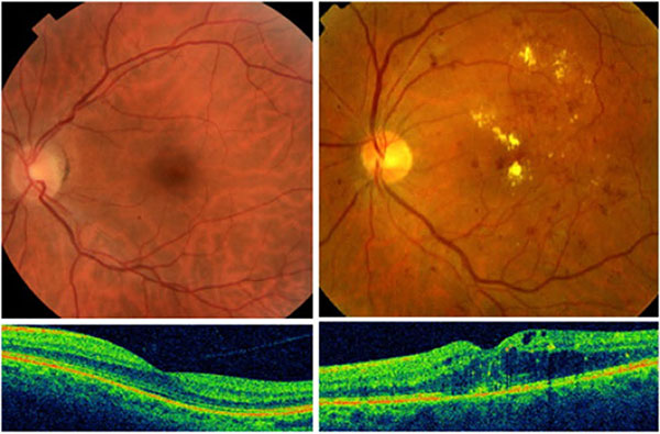 Diabetic Retinopathy in Delhi by Synergy Eye Care