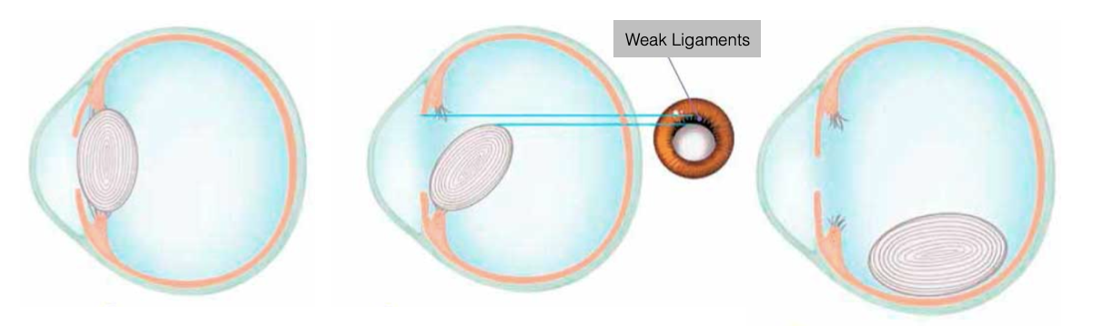 volume preambule Weg Posterior Dislocation of Lens - Synergy Eye Care