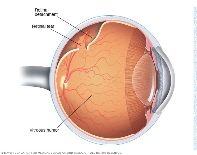 Retinal Detachment Surgery by Synergy Eye Care