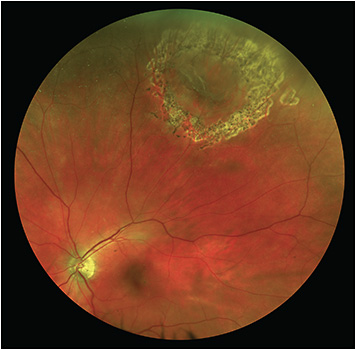 Retinal Detachment Example by Synergy Eye Care