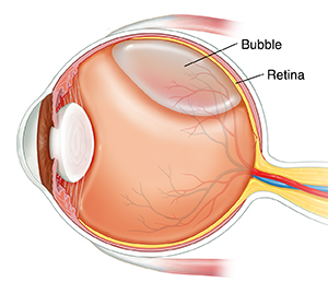 Retinal Detachment Surgery Example by Synergy Eye Care