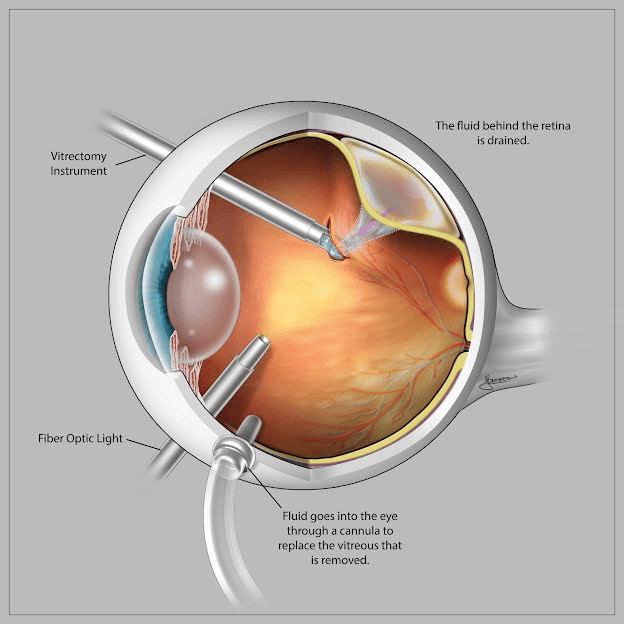 Retinal Detachment Procedure by Synergy Eye Care