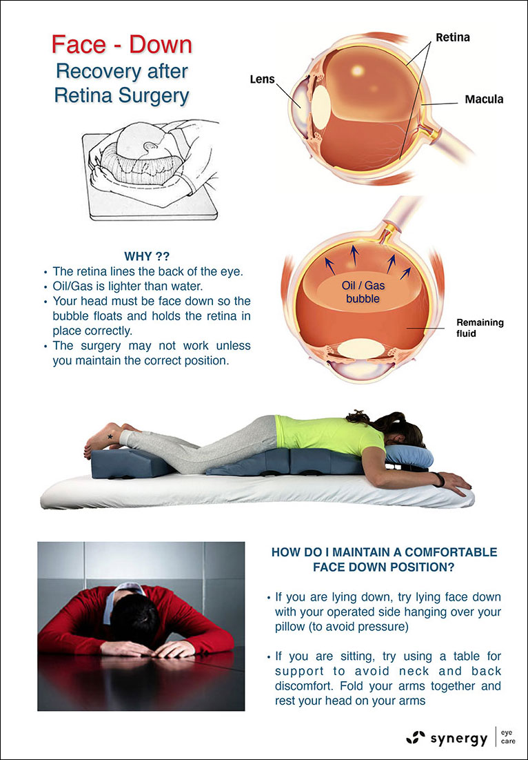 Retinal Detachment After Surgery by Synergy Eye Care