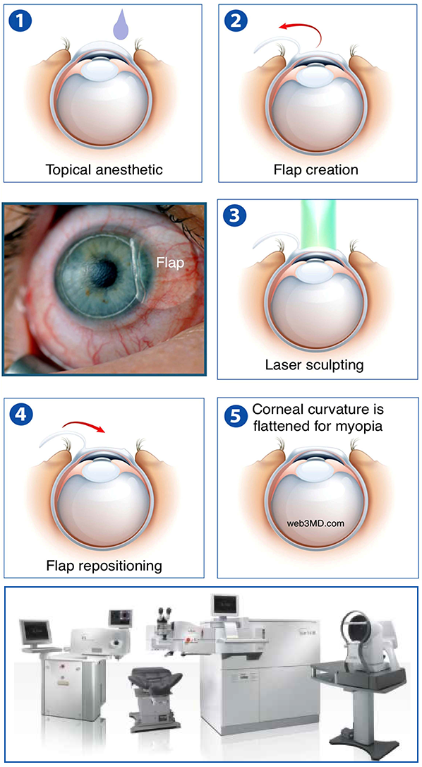 Refractive Errors and LASIK in Delhi by Synergy Eye Care